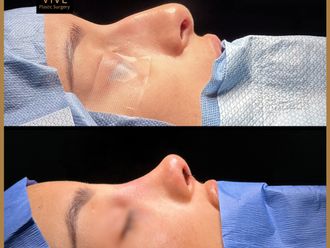 Rinoplastia antes y después - 870394