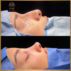 Rinoplastia (rhinoplasty) - Vive Plastic Surgery