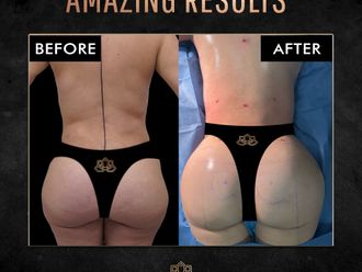 Gluteoplastia antes y después - 870398