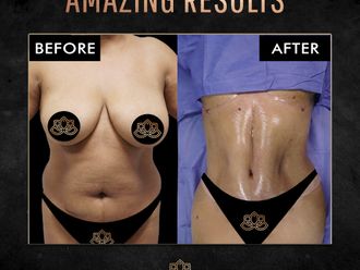 Abdominoplastia antes y después - 870532