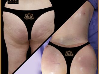 Gluteoplastia antes y después - 870635