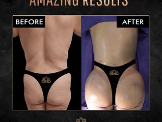 Gluteoplastia antes y después - 870970