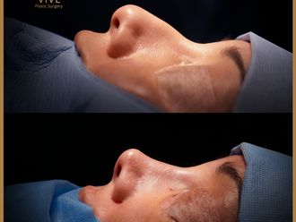 Rinoplastia antes y después - 870971