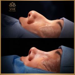 Rinoplastia (rhinoplasty) - Vive Plastic Surgery