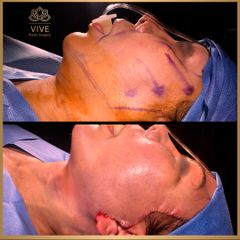 Cirugia facial (Face Lift) - Vive Plastic Surgery