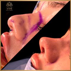 Rinoplastia (rhinoplasty) - Vive Plastic Surgery