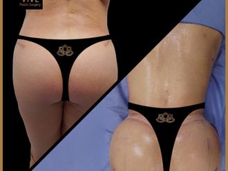 Gluteoplastia antes y después - 871303