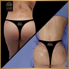 Gluteoplastia, (BBL) - Vive Plastic Surgery