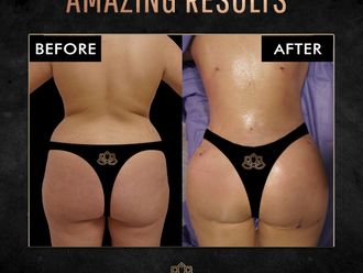 Gluteoplastia antes y después - 871407