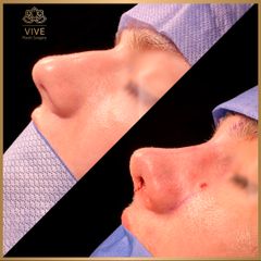 Rinoplastia (rhinoplasty) - Vive Plastic Surgery