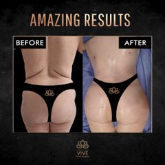 Gluteoplastia - Vive Plastic Surgery