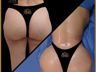 Gluteoplastia antes y después - 872198