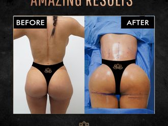 Gluteoplastia antes y después - 872202