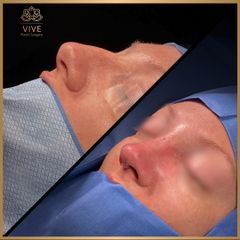 Rinoplastia  - Vive Plastic Surgery