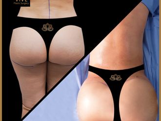 Gluteoplastia antes y después - 872342