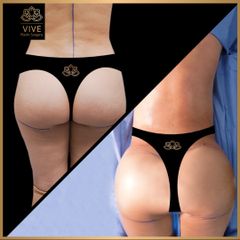 Gluteoplastia - Vive Plastic Surgery