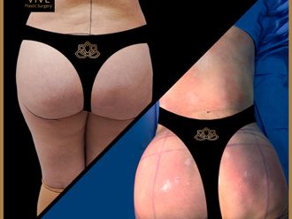 Gluteoplastia antes y después - 872376