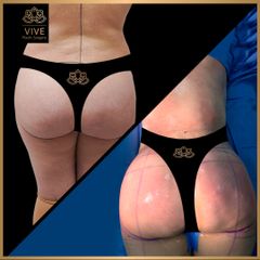 Gluteoplastia, (BBL) - Vive Plastic Surgery