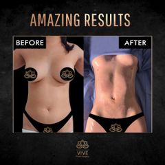 Liposuccion - Vive Plastic Surgery