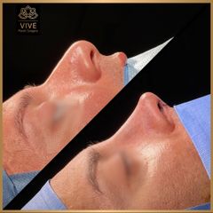 Rinoplastia (rhinoplasty) - Vive Plastic Surgery