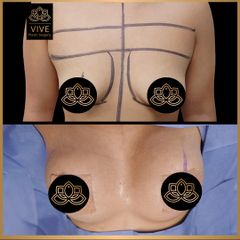 Aumento de busto (breast implants) - Vive Plastic Surgery