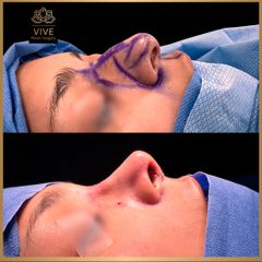 Rinoplastia (rhinoplasty) - Vive Plastic Surgery