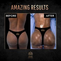 Gluteoplastia, (BBL) - Vive Plastic Surgery