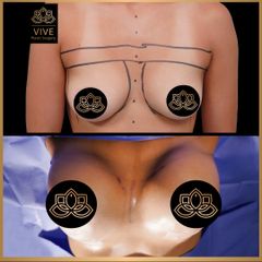 Aumento de busto (breast implants) - Vive Plastic Surgery