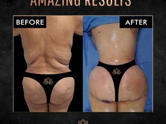 Gluteoplastia antes y después - 873227