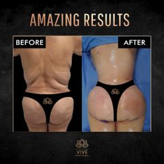 Gluteoplastia, (BBL) - Vive Plastic Surgery