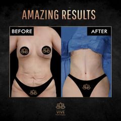 Abdominoplastia (tummy tuck) - Vive Plastic Surgery