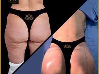 Gluteoplastia antes y después - 873358