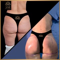 Gluteoplastia, (BBL) - Vive Plastic Surgery