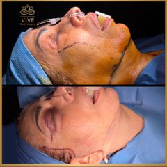 Cirugía facial (Face Lift) - Vive Plastic Surgery