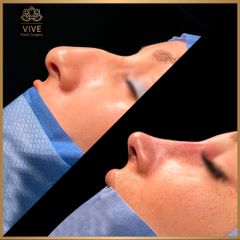 Rinoplastia (rhinoplasty) - Vive Plastic Surgery