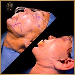 Cirugía facial (Face Lift) - Vive Plastic Surgery