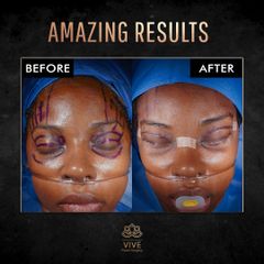 Blefaroplastia - Vive Plastic Surgery