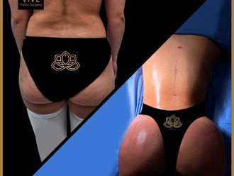 Gluteoplastia antes y después - 873454