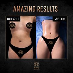 Lipoescultura - Vive Plastic Surgery