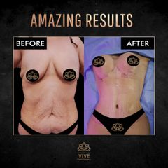 Mommy Makeover - Vive Plastic Surgery