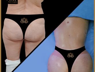 Gluteoplastia antes y después - 873642