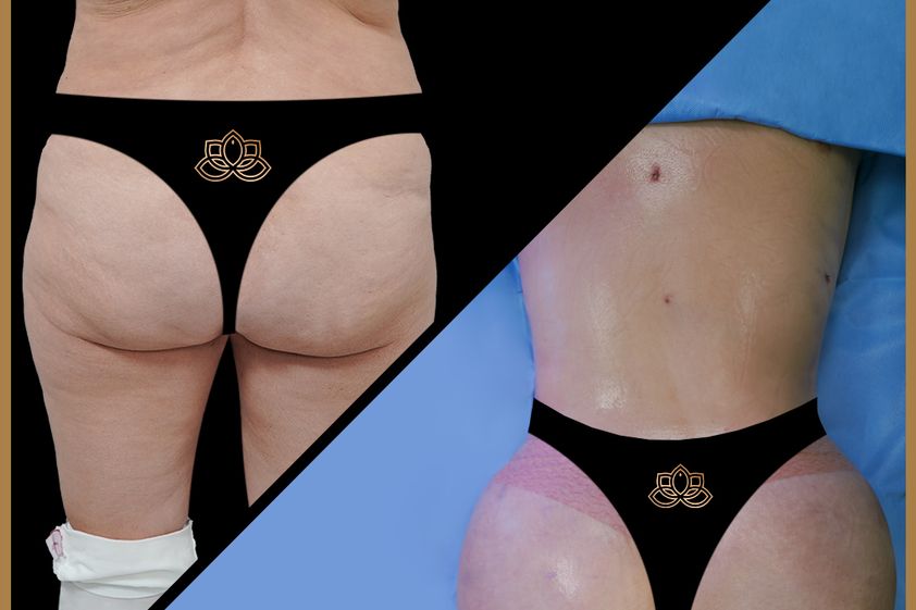 Gluteoplastia antes y después - 873642