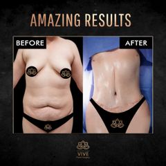 Abdominoplastia (Tummy Tuck) - Abdominoplastia