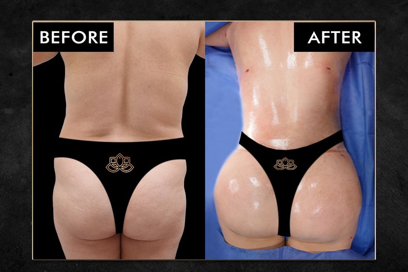 Gluteoplastia antes y después - 874079