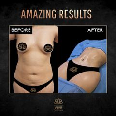 Abdominoplastia (Tummy Tuck) - Vive Plastic Surgery