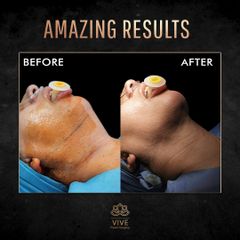 Cirugia de papada (Chin Lipo) - Vive Plastic Surgery