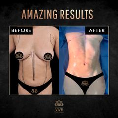 Liposuccion - Vive Plastic Surgery