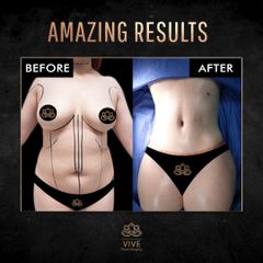 Abdominoplastia (Tummy Tuck) - Vive Plastic Surgery