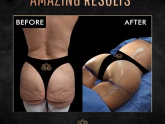 Gluteoplastia antes y después - 874231