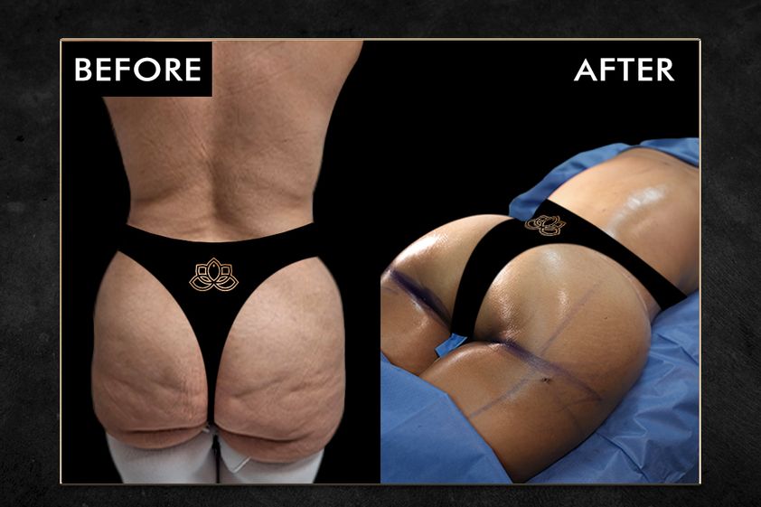 Gluteoplastia antes y después - 874231
